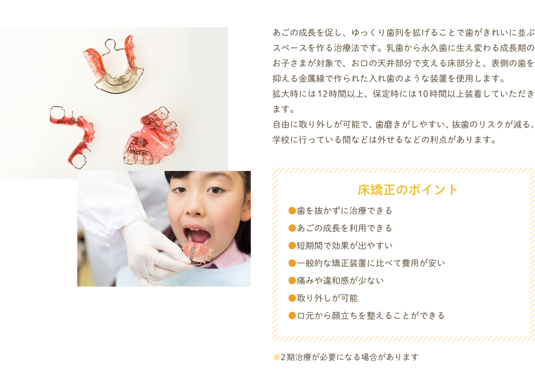 あごの成長を促し、ゆっくり歯列を拡げることで歯がきれいに並ぶスペースを作る治療法です。乳歯から永久歯に生え変わる成長期のお子さまが対象で、お口の天井部分で支える床部分と、表側の歯を抑える金属線で作られた入れ歯のような装置を使用します。
拡大時には12時間以上、保定時には10時間以上装着していただきます。
自由に取り外しが可能で、歯磨きがしやすい、抜歯のリスクが減る、学校に行っている間などは外せるなどの利点があります。
